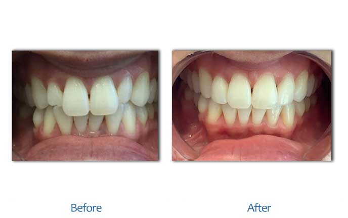 After Before image of Dental treatment