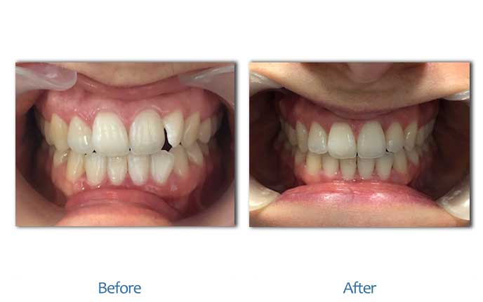 After Before image of Dental treatment