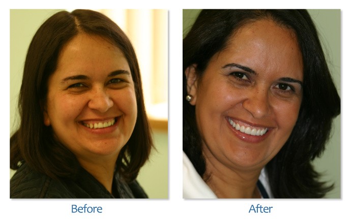 After Before image of Dental treatment