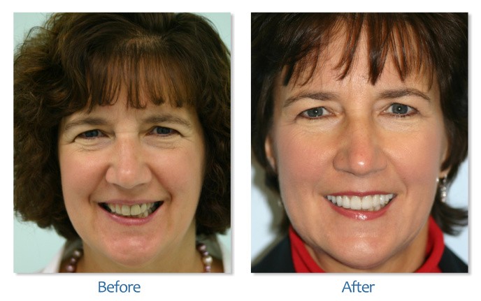 After Before image of Dental treatment