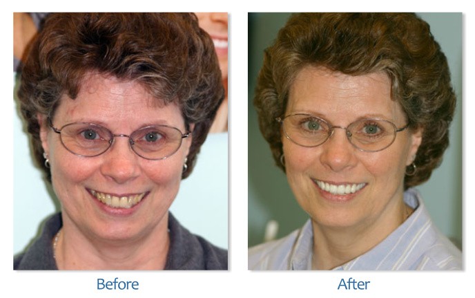 After Before image of Dental treatment