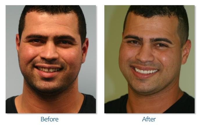 After Before image of Dental treatment