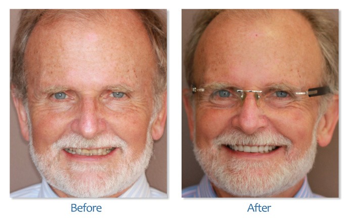 After Before image of Dental treatment