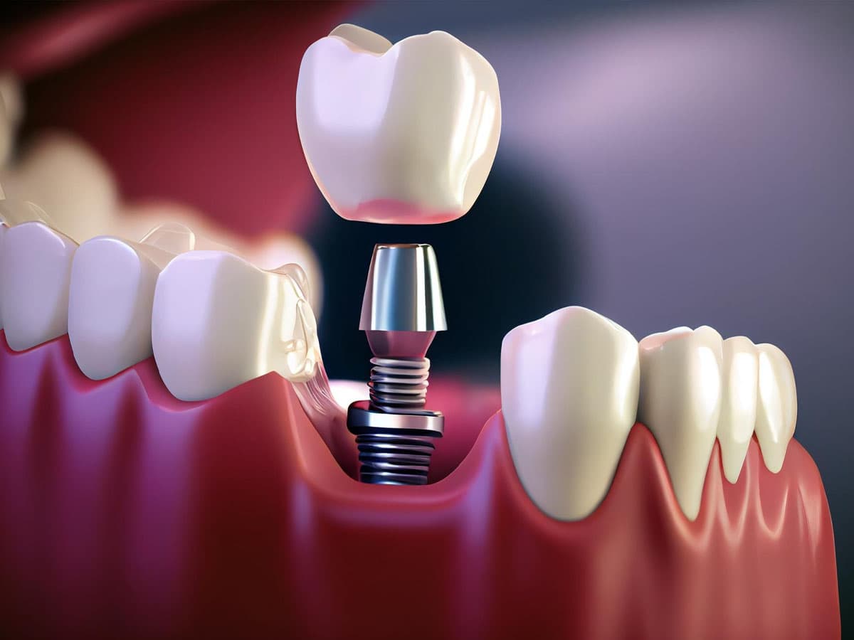 dental implants