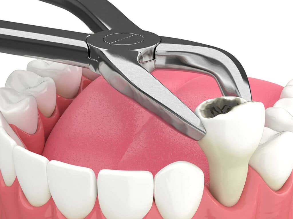 5 Things You Should Know Before Getting a Tooth Extraction